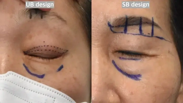 上睑成形术, 与眉下提升术