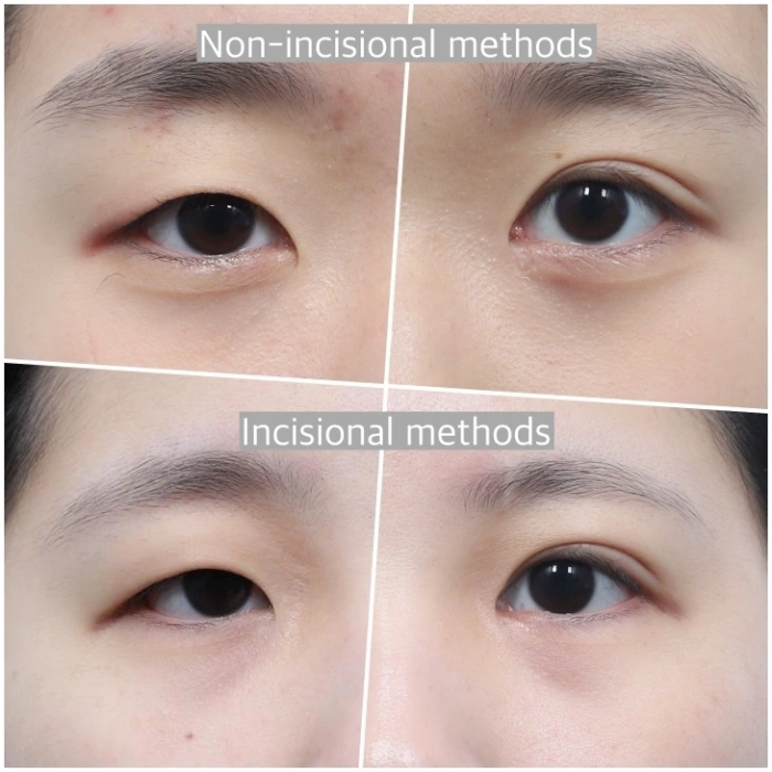 جراحة الجفن المزدوج في كوريا