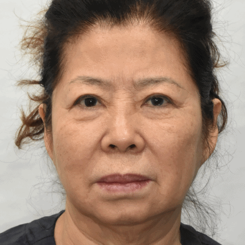 Noonopi面部年轻化术后2个月效果