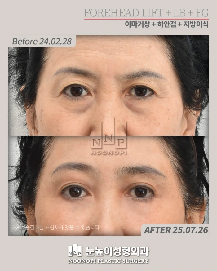 كوريا جراحة التجميل قبل وبعد