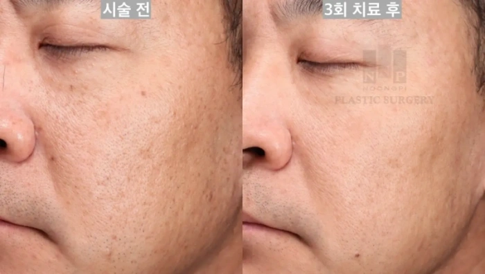 BBL 히어로 치료 고객 사례