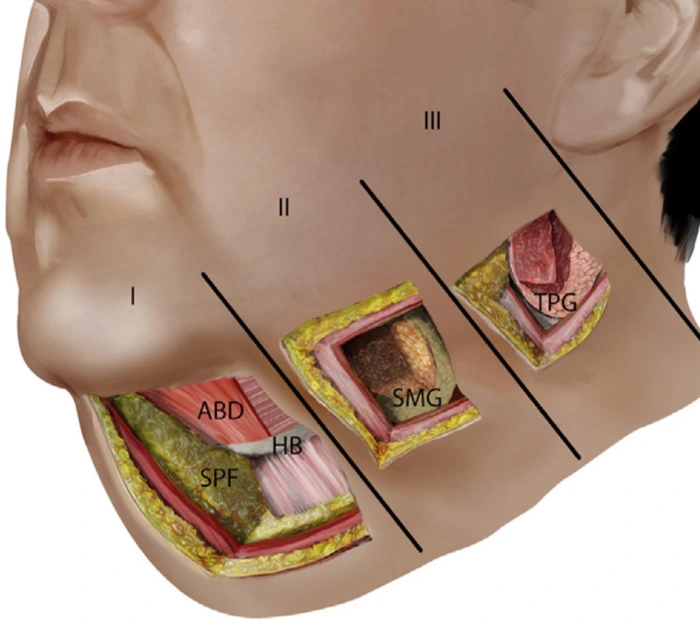 A diagram illustrating the cause of a double chin from excess submental fat