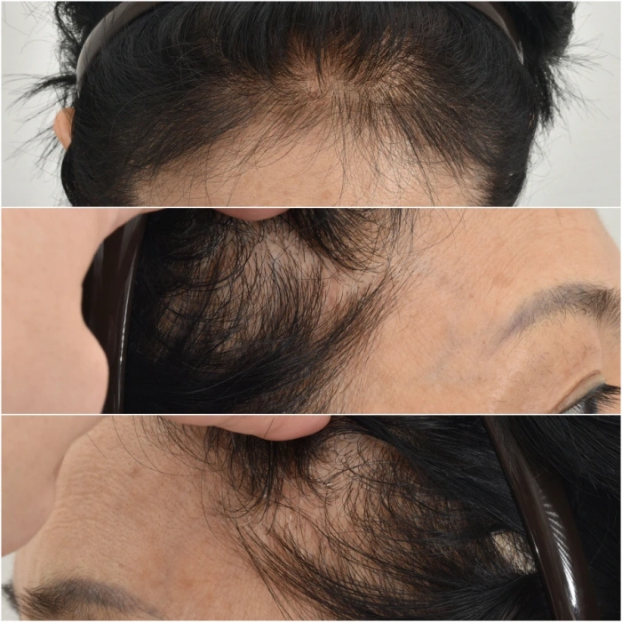 endoscopic brow lift incisions in the hairline