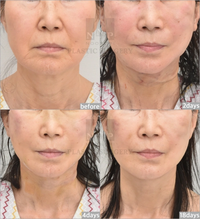 面颈部提升术及脂肪移植术早期恢复照片