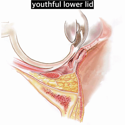 تغيرات الشيخوخة في الجفن السفلي