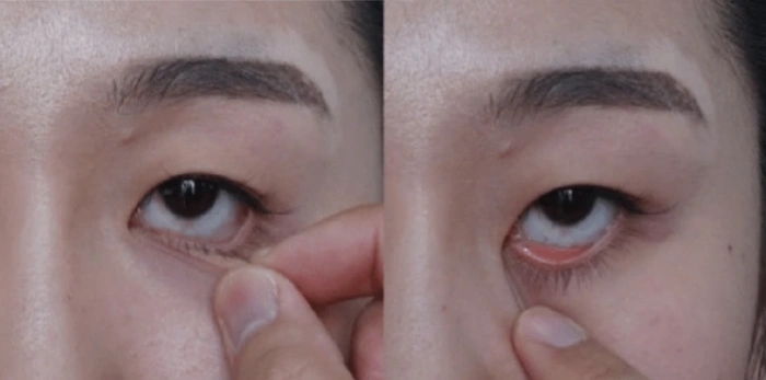 اختبار قبل الجراحة لإجراء جراحة آمنة للجفن السفلي