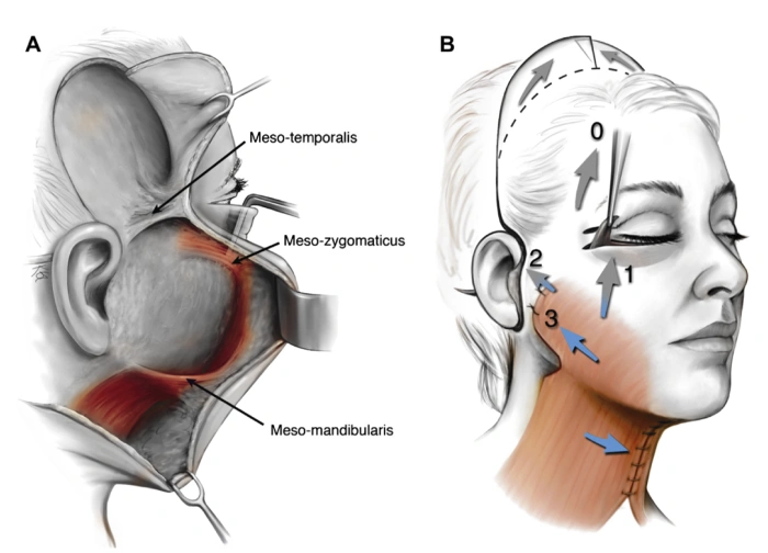 Anatomy illustration showing the continuous connection between the facial SMAS layer and the neck platysma muscle.