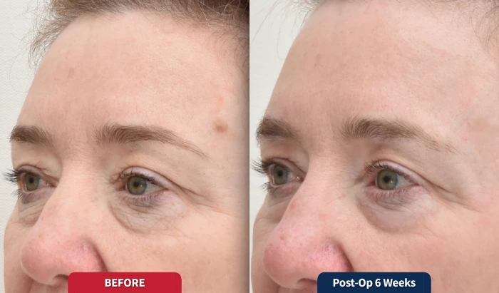 Seamless healing in lighter skin types without PIH