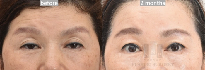 Endoscopic forehead lift results with ptosis treated