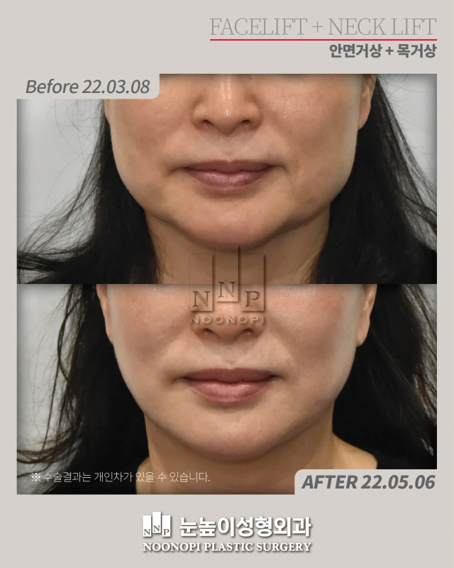 lower facelift in Korea for marionette lines