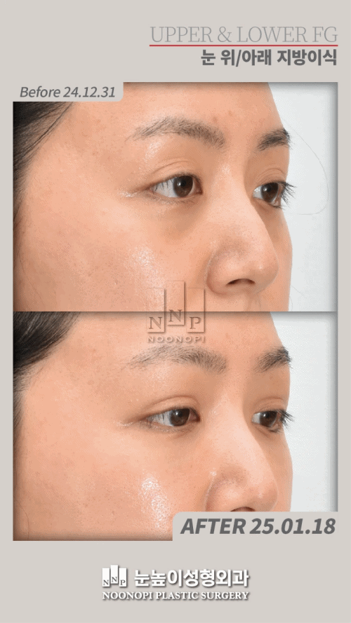 بعد 18 يومًا من حقن الدهون في الجفن العلوي والسفلي