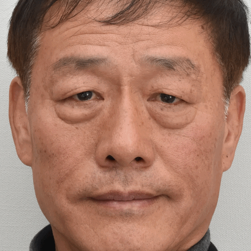 术前患者借助额肌上提眉眼