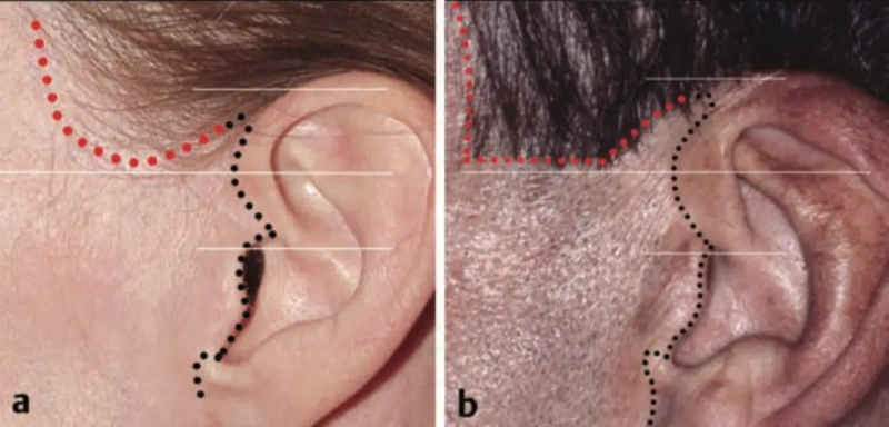 الشق الموصى به لإجراء عملية شد الوجه للحفاظ على خط الشعر الطبيعي