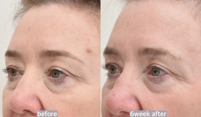 lower lid laser wrinkle treatment