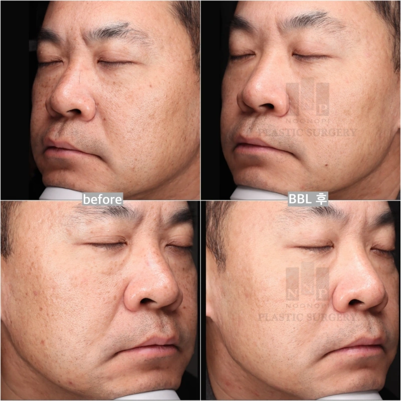 Freckle and pigment treatment results