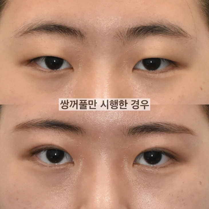 double eyelid only without ptosis surgery