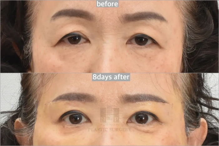 眉下提升术后8天