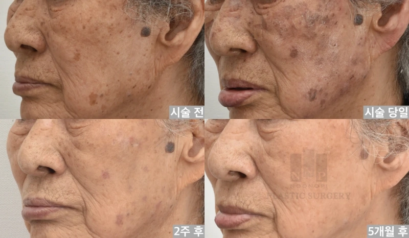 Overdone treatment case to my Grandmother (1 sessions: pre, immediate post, 2weeks, 5months after)
