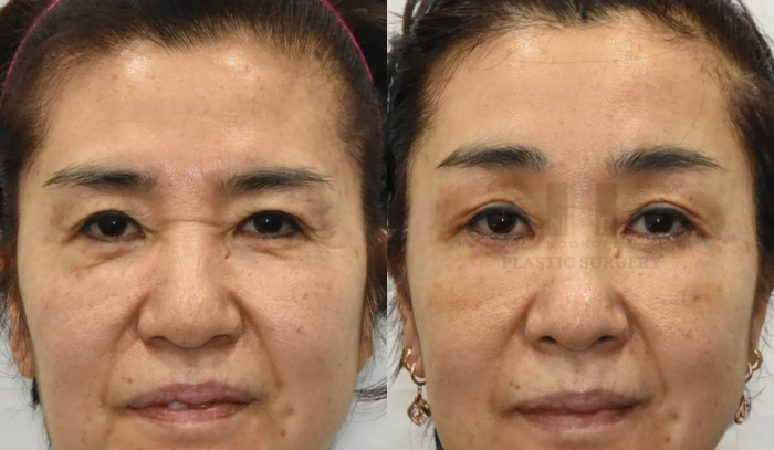 قبل وبعد عملية رفع الحاجب لامرأة في الستينيات من عمرها