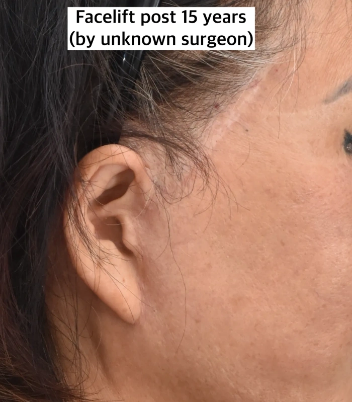 本案例采用发际内切口，但因切除皮肤量过大，最终导致鬓角消失且发际线后移