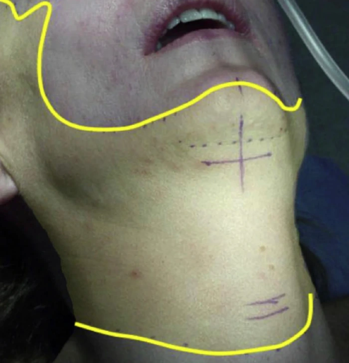 Combined facelift and neck lift in one surgery