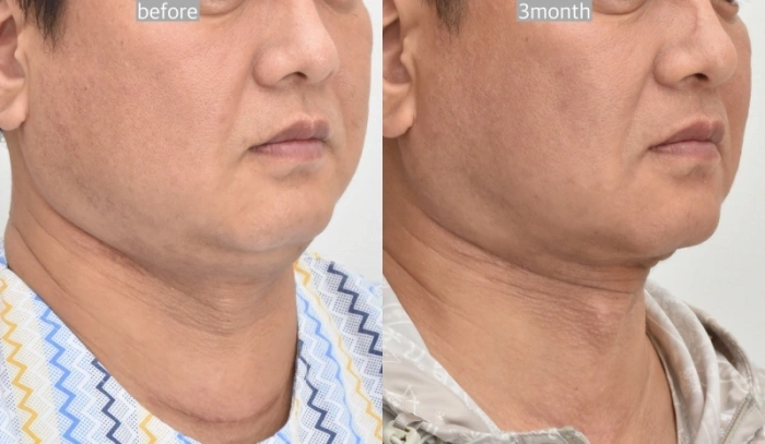 عملية شد الرقبة على الطريقة الكورية قبل وبعد