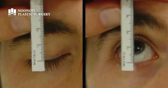 Measuring levator muscle function using Berke's Method
