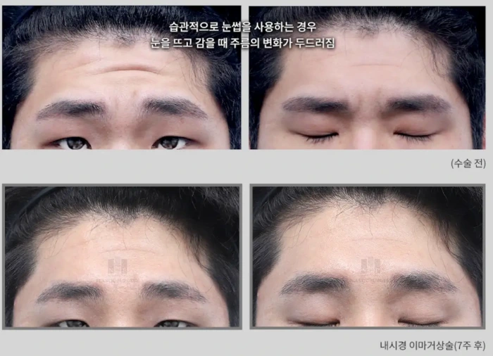 Habitual forehead straining can be relieved after surgery