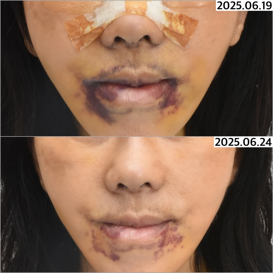 facial surgery bruise treatment