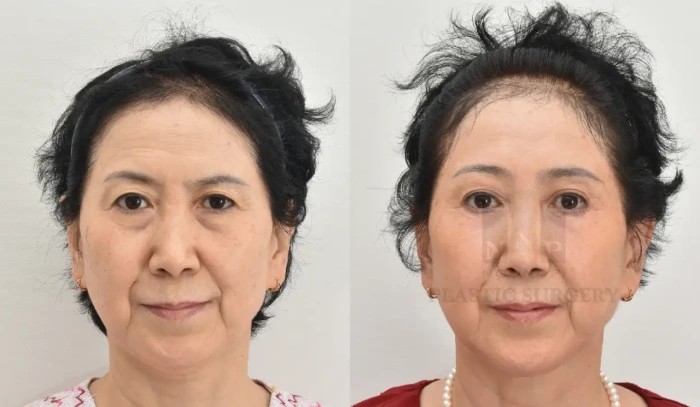 Hollow eyelid can be prevented if fat graft are combined