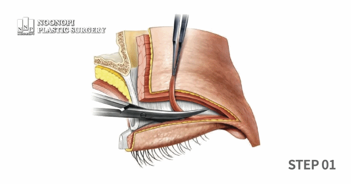 쌍꺼풀수술 과정을 설명하는 일러스트레이션