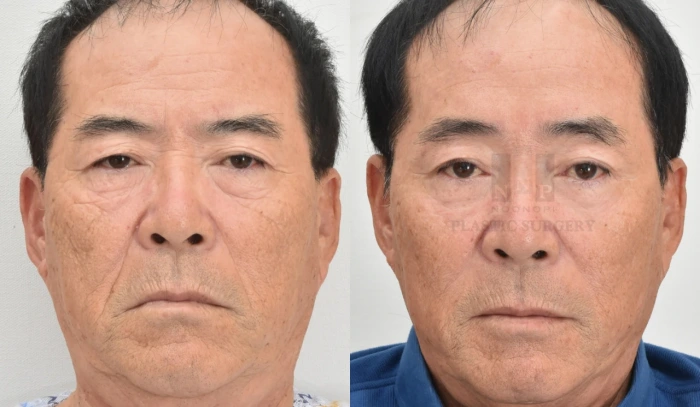 这是一位60岁女性在接受额部填充手术前后的对比照片