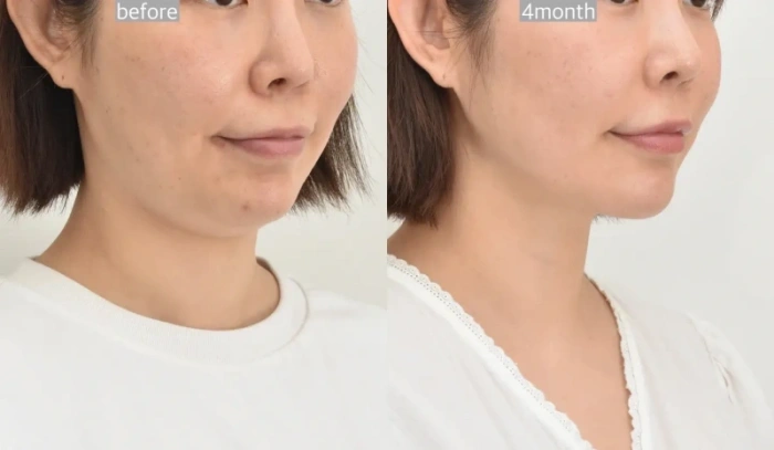 دلايات الرقبة في كوريا