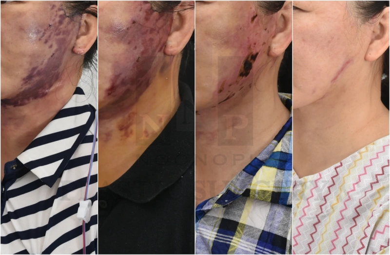 面部提升副作用高压氧治疗前后对比