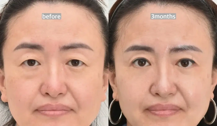 الجفن العلوي والسفلي قبل وبعد من Noonopi