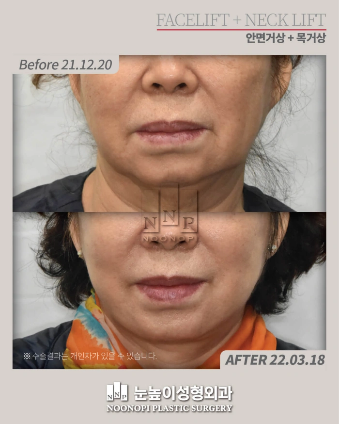 results of SMAS facelift in seoul, korea