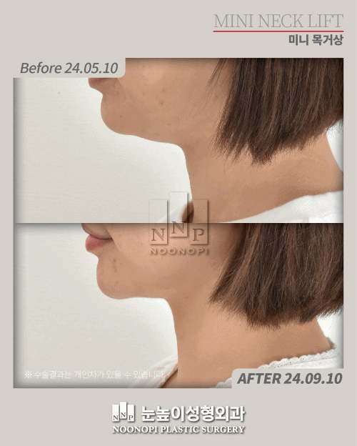 double chin surgery before after