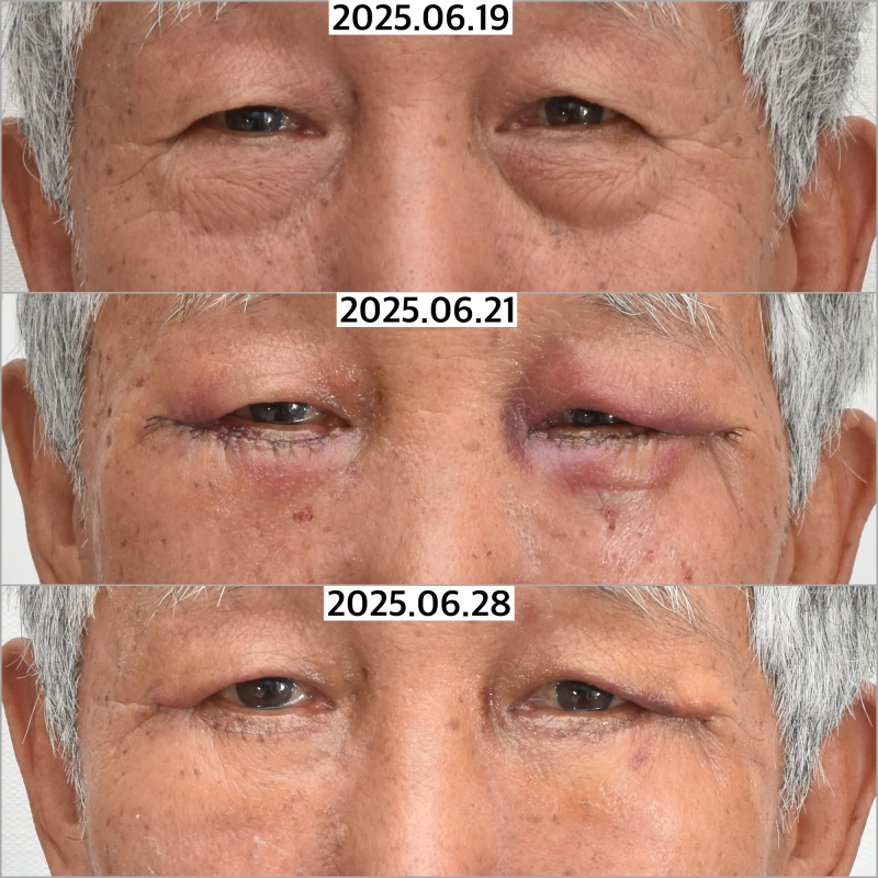 안검외반 예방을 위해 골막고정을 시행한 사진