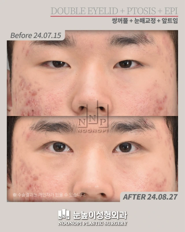 korea ptosis before after