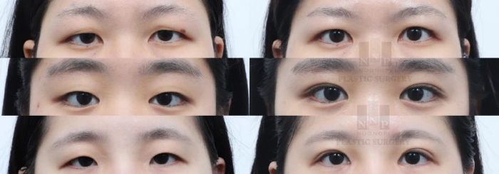 before and after photos of double eyelid surgery in Korea