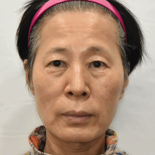 lower blepharoplasty Korea