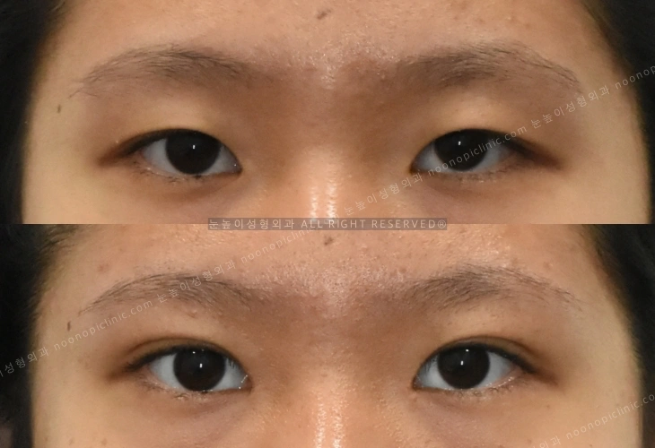 仅埋线双眼皮手术后瞳孔仍显大的情况