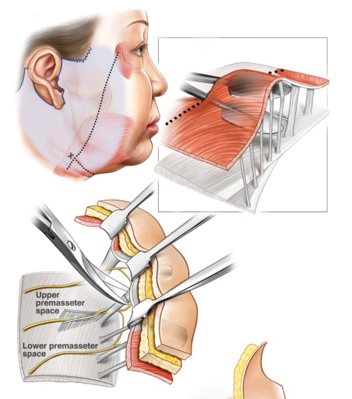رسم توضيحي لشد الوجه العميق (رابط مرجعي):