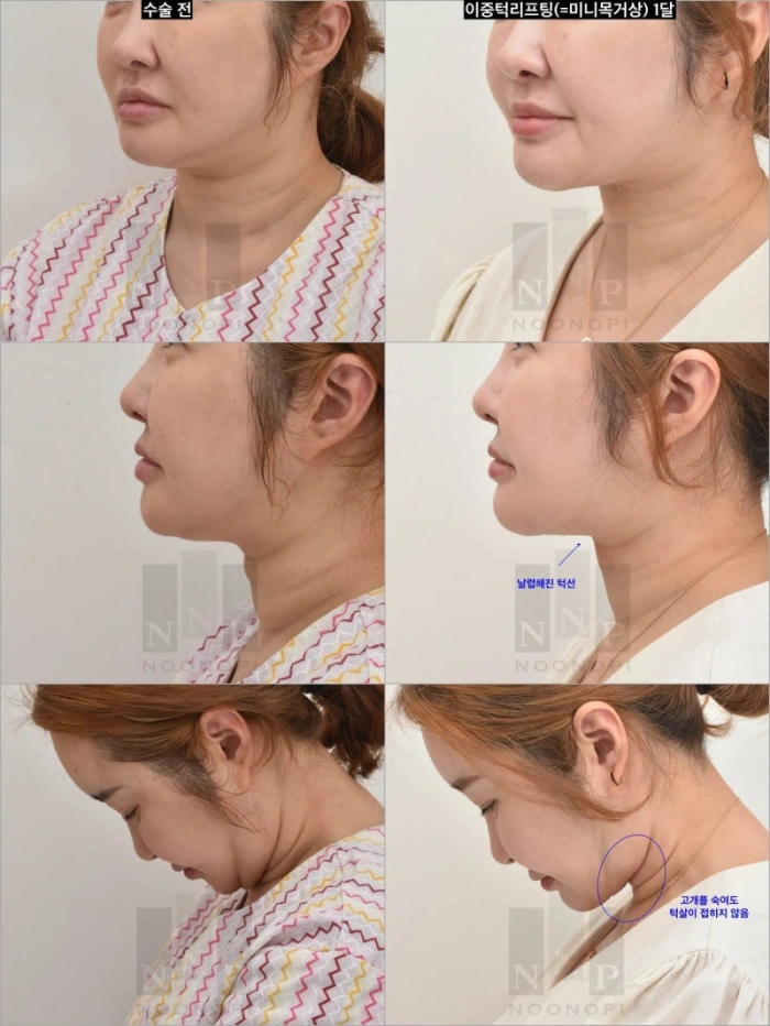 双下巴治疗微创颈部提升术案例