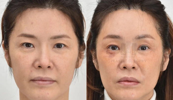 韩国提眉术前后对比