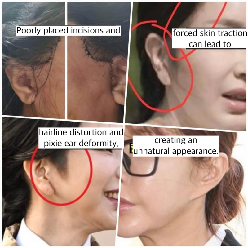 韩国明星面部提升副作用:因切口规划不当导致发际线变形(上图已进行纹身修复)及耳垂畸形