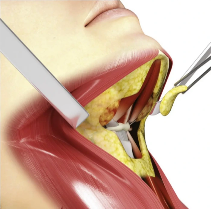 Removal of deep neck fat