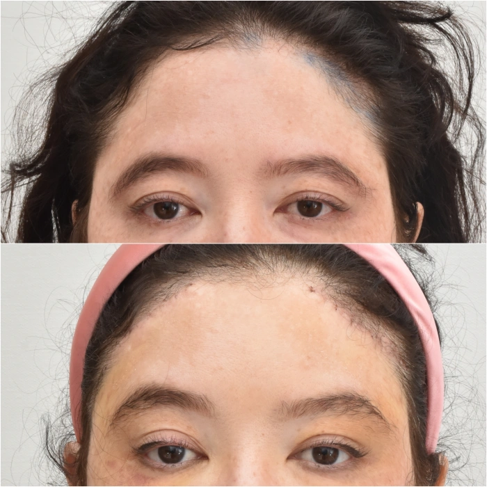 korea fox eye lift surgery