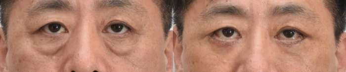 lower blepharoplasty results in 50s male