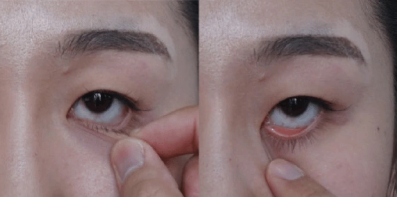 eyelid laxity tests